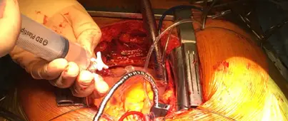 Injektion von Cardioplexol in die Aortenwurzel, Prof. Christoph Huber Universitätskrankenhaus Genf